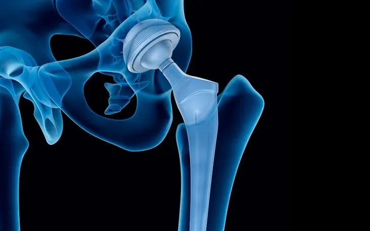Illustration of a hip replacement implant (arthroplasty)