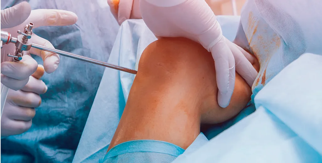 Knee arthroscopy, a minimally invasive procedure