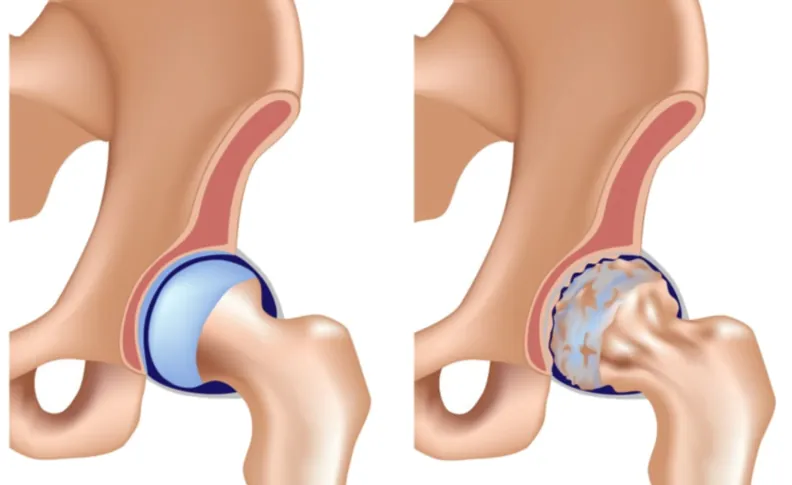 Illustration comparing a healthy hip and a hip with osteoarthritis