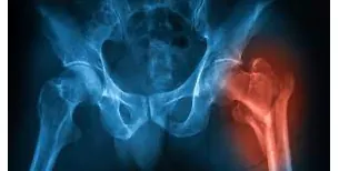 Hip X-ray highlighting the femoral neck region