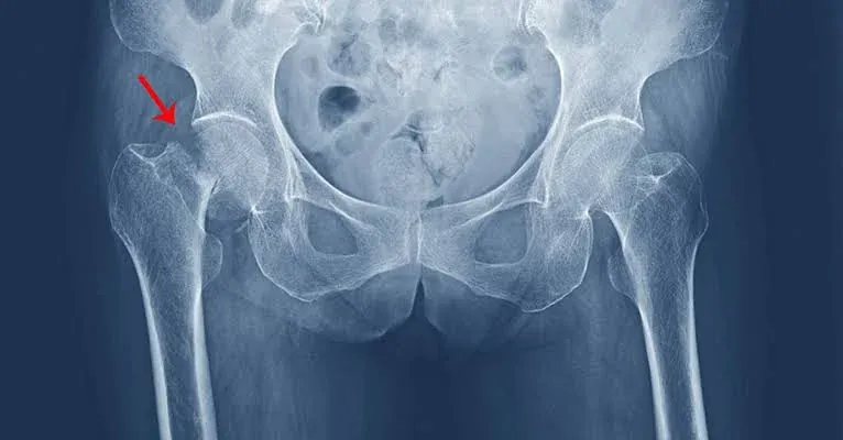 Pelvis X-ray with an arrow pointing to a fracture