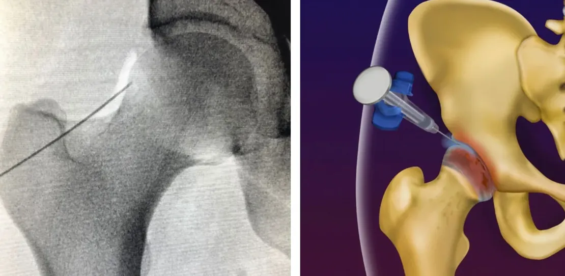 Infiltração no quadril guiada por radioscopia e ilustração da articulação