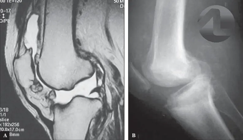 MRI and X-ray of the knee