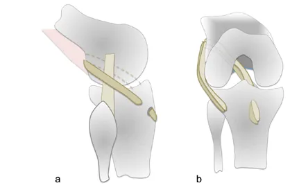 Drawing of the bone tunnel and graft in ACL reconstruction