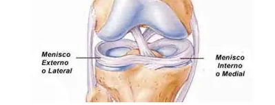 Illustration of the medial and lateral menisci of the knee