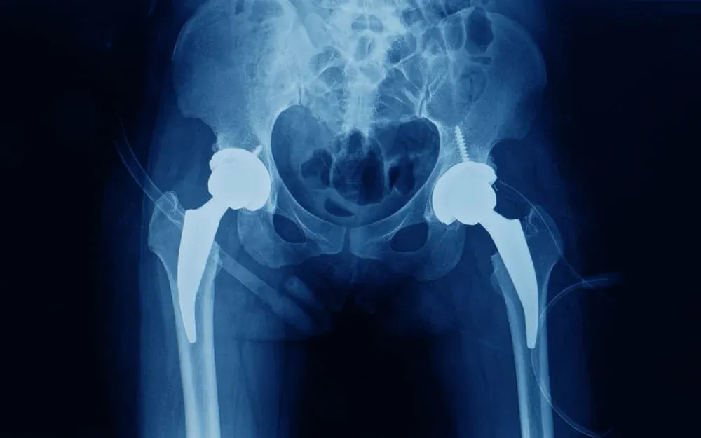 X-ray of a pelvis with a hip replacement