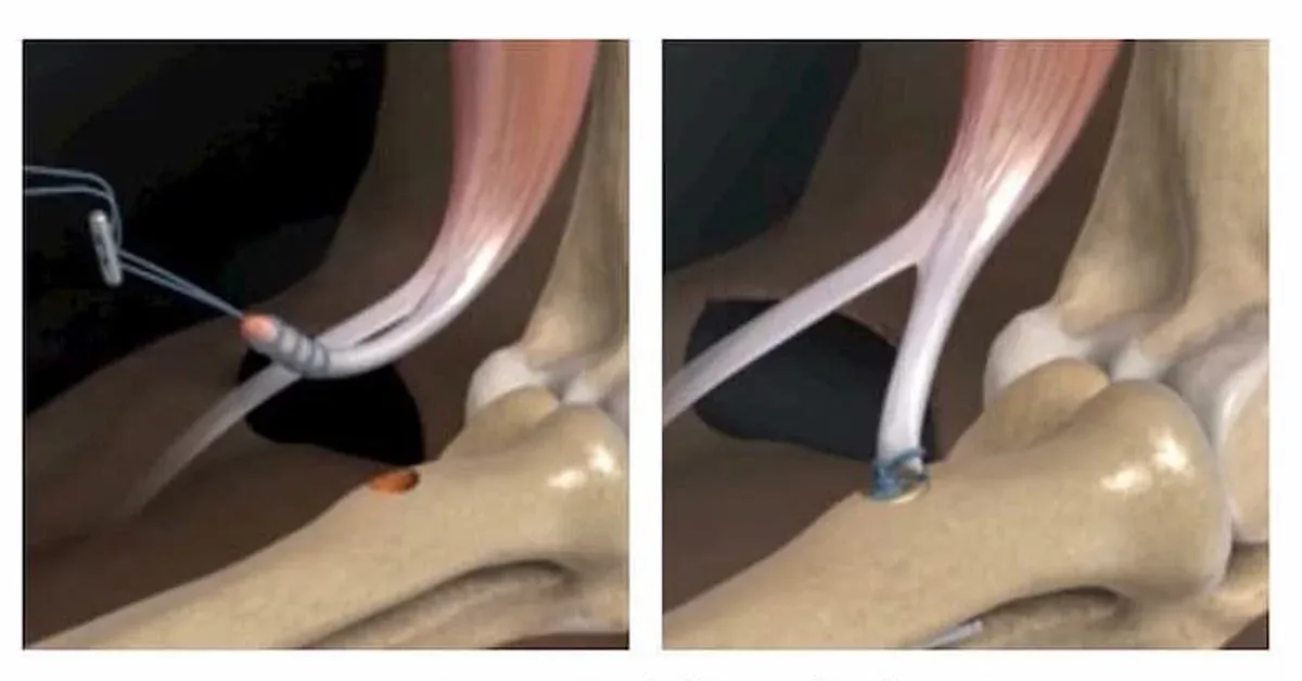 Illustration of a distal biceps tendon rupture at the elbow