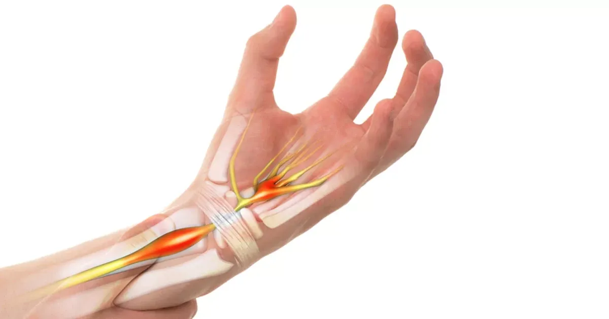 Illustration of the median nerve compressed in the carpal tunnel